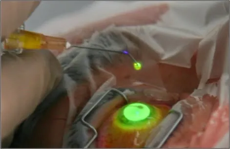 Riboflavin glowing on the cornea under UV light during a cross-linking procedure